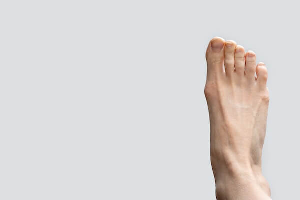 Opération d'un hallux valgus