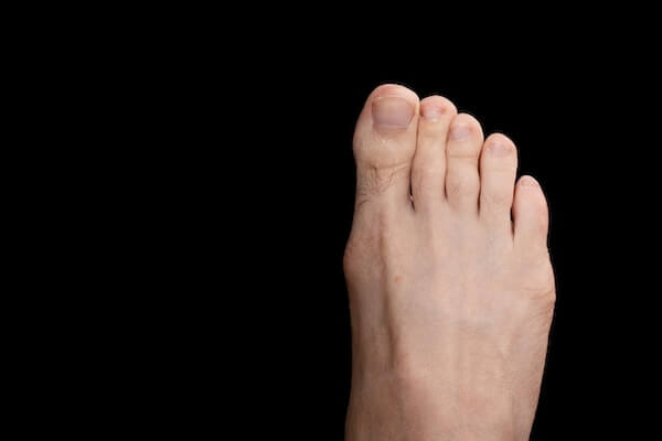 Opération d'un hallux valgus